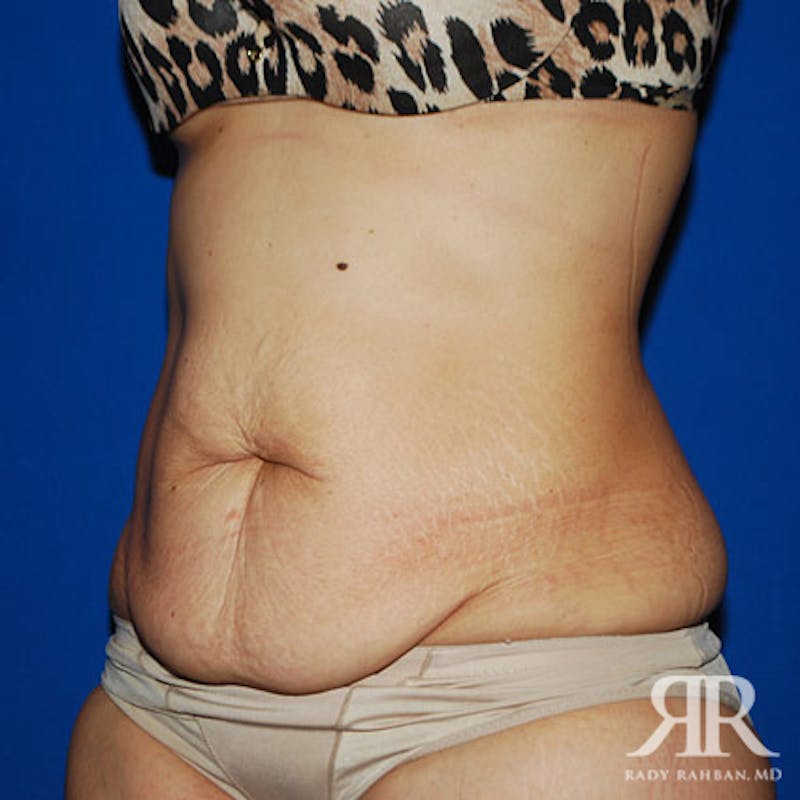 Tummy Tuck Before & After Gallery - Patient 170077 - Image 3
