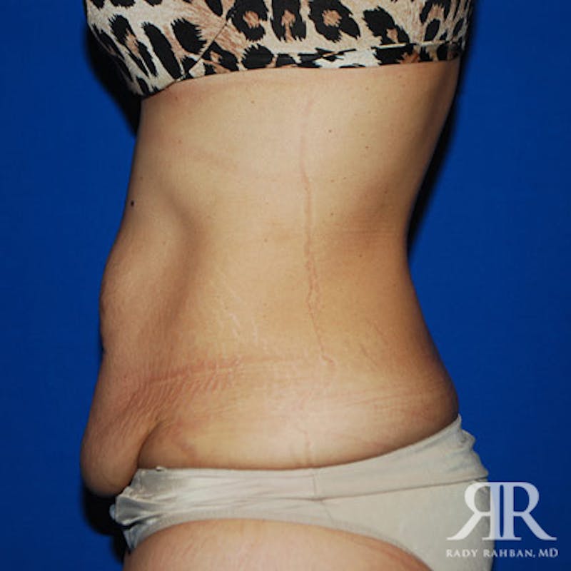 Tummy Tuck Before & After Gallery - Patient 170077 - Image 5