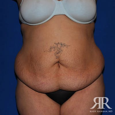Tummy Tuck Before & After Gallery - Patient 384823 - Image 1