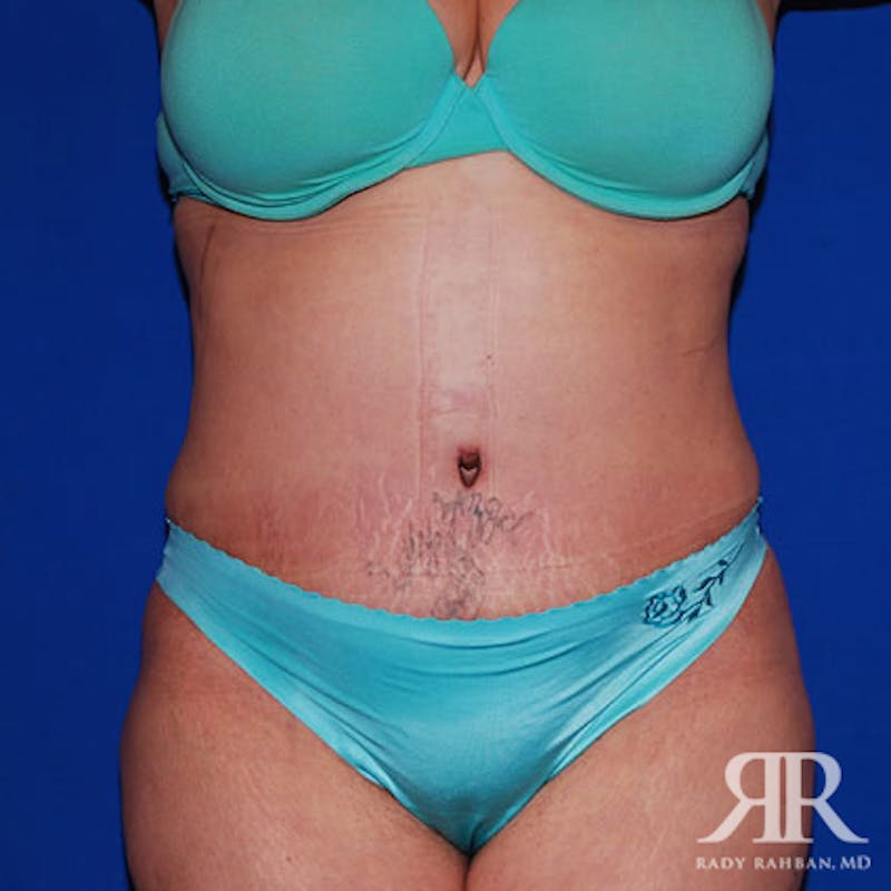 Tummy Tuck Before & After Gallery - Patient 384823 - Image 2