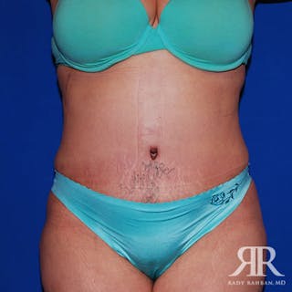 Tummy Tuck Before & After Gallery - Patient 384823 - Image 2