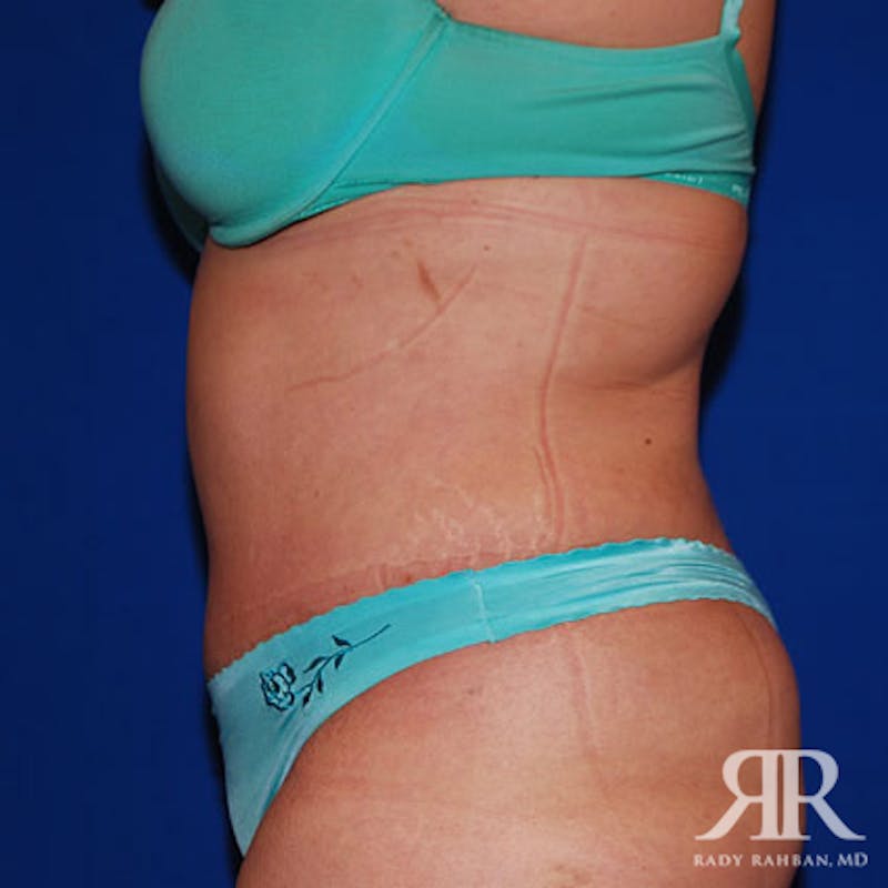 Tummy Tuck Before & After Gallery - Patient 384823 - Image 4