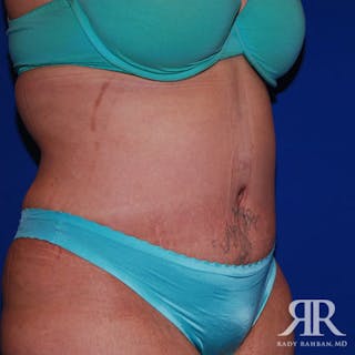 Tummy Tuck Before & After Gallery - Patient 384823 - Image 6