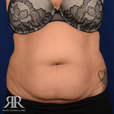 Tummy Tuck Before & After Gallery - Patient 142597 - Image 1