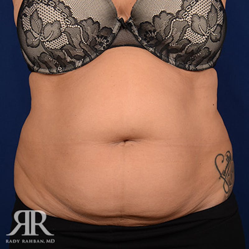 Tummy Tuck Before & After Gallery - Patient 142597 - Image 1