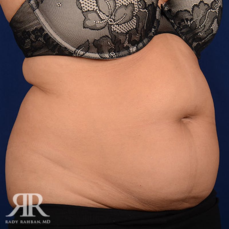 Tummy Tuck Before & After Gallery - Patient 142597 - Image 3