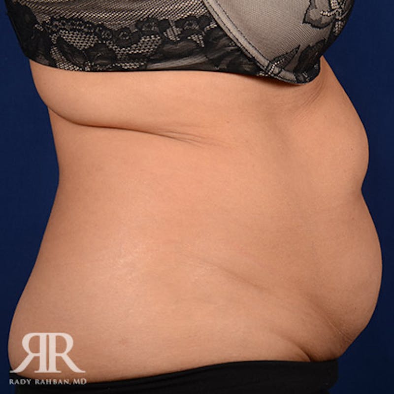 Tummy Tuck Before & After Gallery - Patient 142597 - Image 5