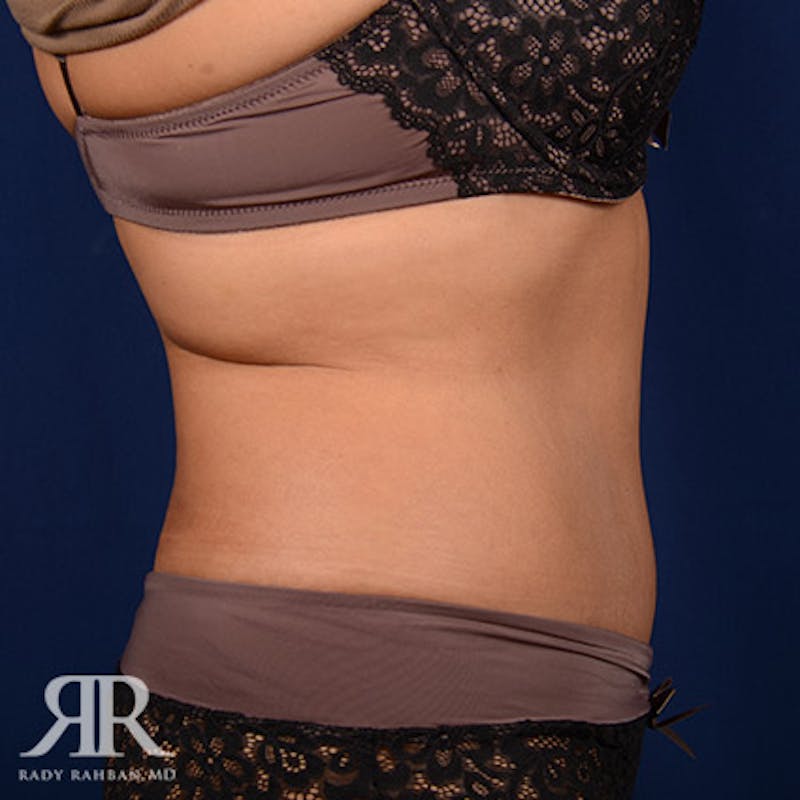 Tummy Tuck Before & After Gallery - Patient 142597 - Image 6