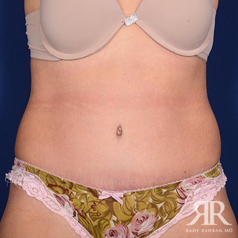 Tummy Tuck Before & After Gallery - Patient 249148 - Image 2
