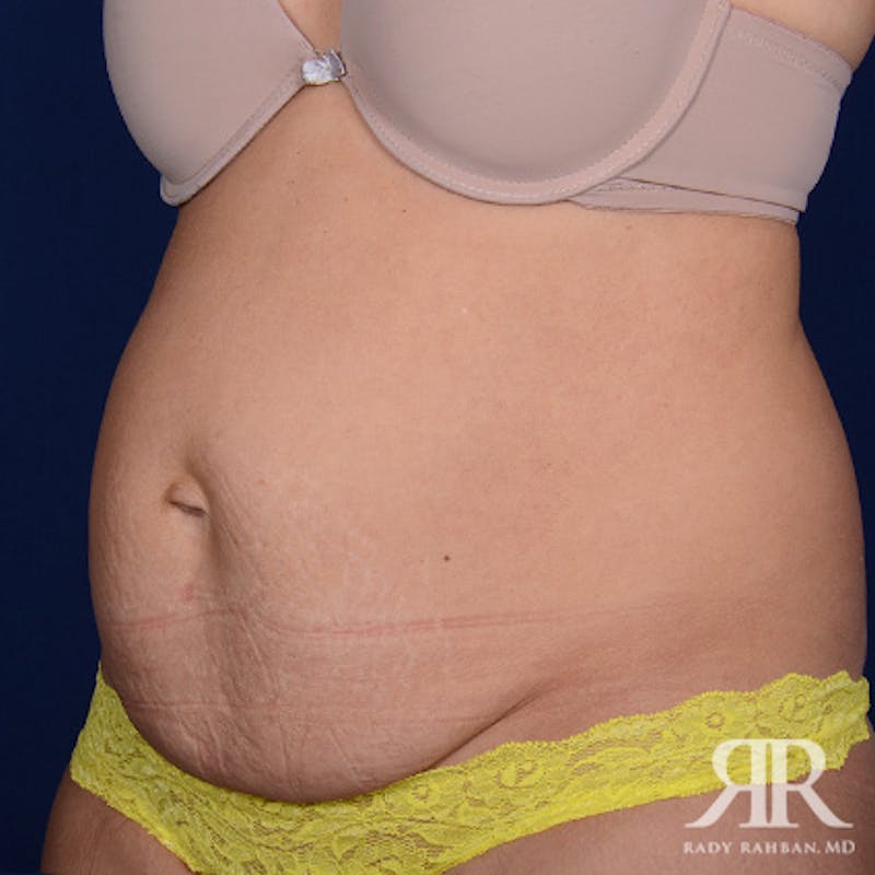 Tummy Tuck Before & After Gallery - Patient 249148 - Image 3
