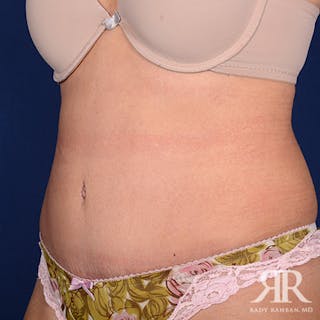 Tummy Tuck Before & After Gallery - Patient 249148 - Image 4