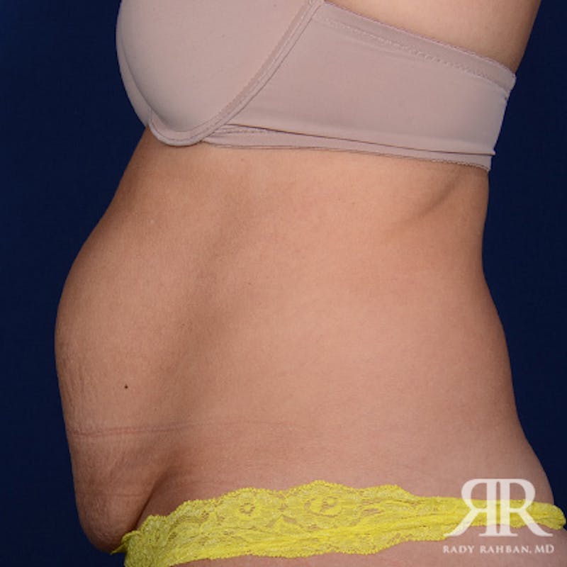 Tummy Tuck Before & After Gallery - Patient 249148 - Image 5