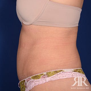 Tummy Tuck Before & After Gallery - Patient 249148 - Image 6