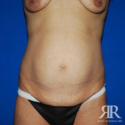 Tummy Tuck Before & After Gallery - Patient 354033 - Image 1