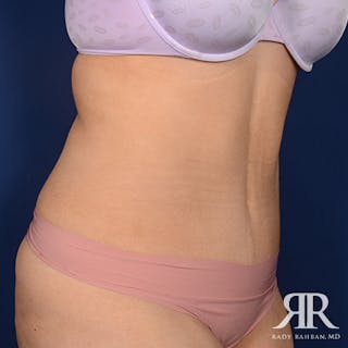 Tummy Tuck Before & After Gallery - Patient 202475 - Image 4