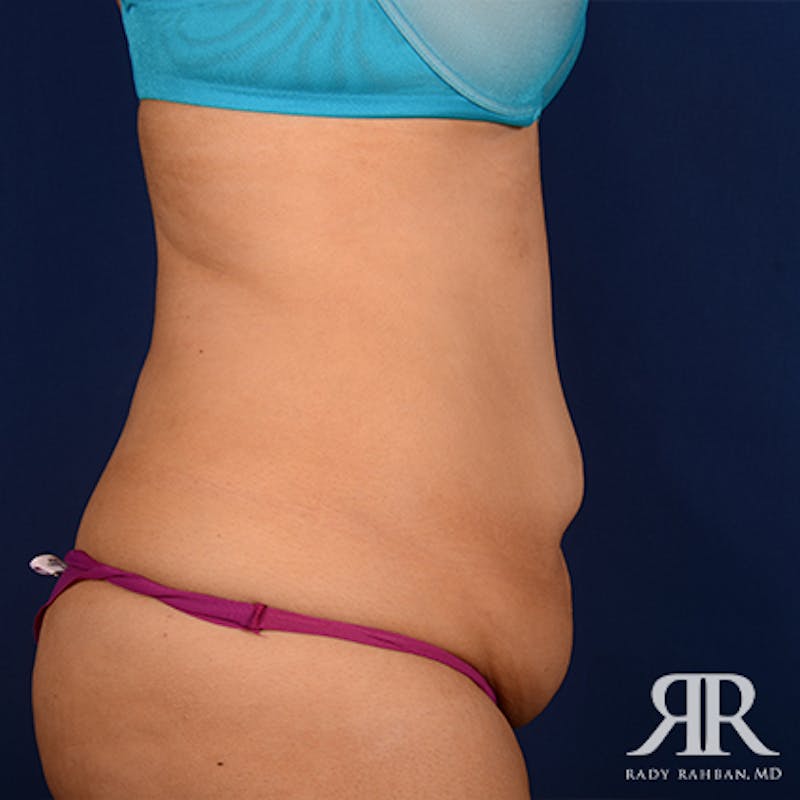 Tummy Tuck Before & After Gallery - Patient 202475 - Image 5