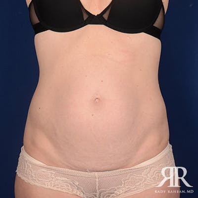 Tummy Tuck Before & After Gallery - Patient 345545 - Image 1