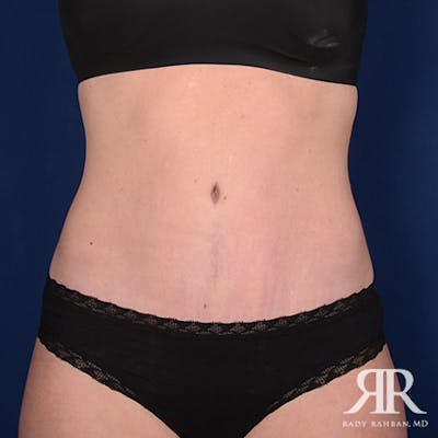 Tummy Tuck Before & After Gallery - Patient 345545 - Image 2