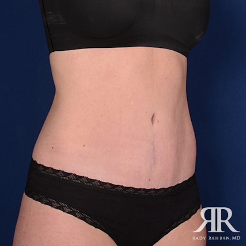 Tummy Tuck Before & After Gallery - Patient 345545 - Image 4