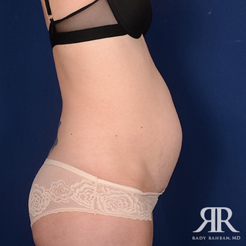 Tummy Tuck Before & After Gallery - Patient 345545 - Image 5