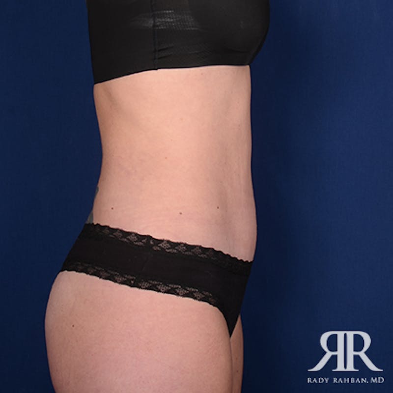 Tummy Tuck Before & After Gallery - Patient 345545 - Image 6