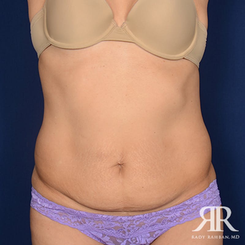 Tummy Tuck Before & After Gallery - Patient 419172 - Image 1