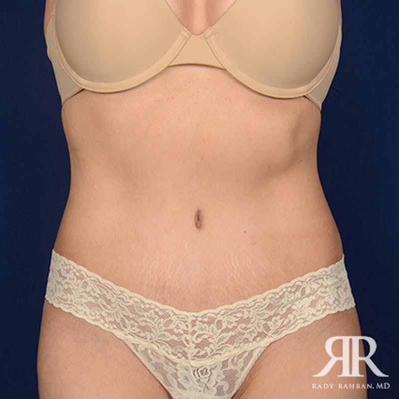 Tummy Tuck Before & After Gallery - Patient 419172 - Image 2