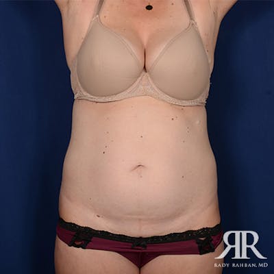 Tummy Tuck Before & After Gallery - Patient 306791 - Image 1