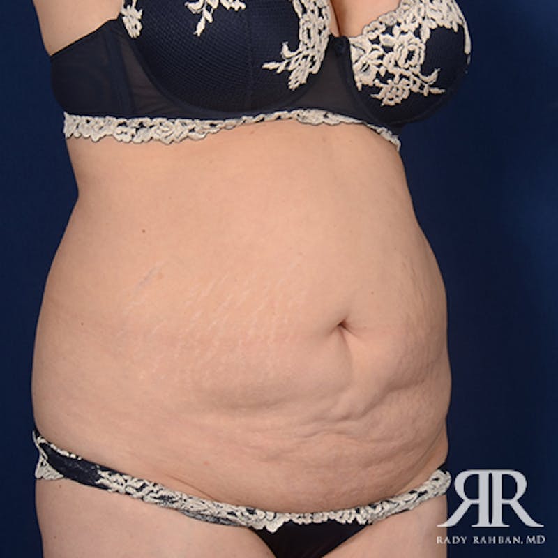 Tummy Tuck Before & After Gallery - Patient 377991 - Image 3