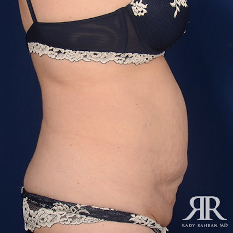 Tummy Tuck Before & After Gallery - Patient 377991 - Image 5