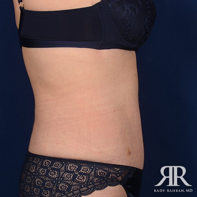 Tummy Tuck Before & After Gallery - Patient 377991 - Image 6