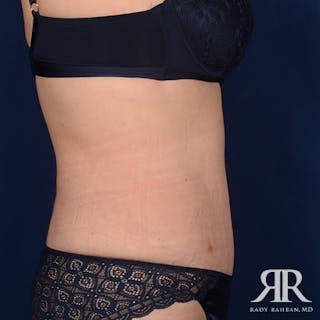 Tummy Tuck Before & After Gallery - Patient 377991 - Image 6