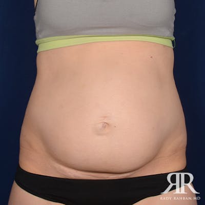 Tummy Tuck Before & After Gallery - Patient 624749 - Image 1