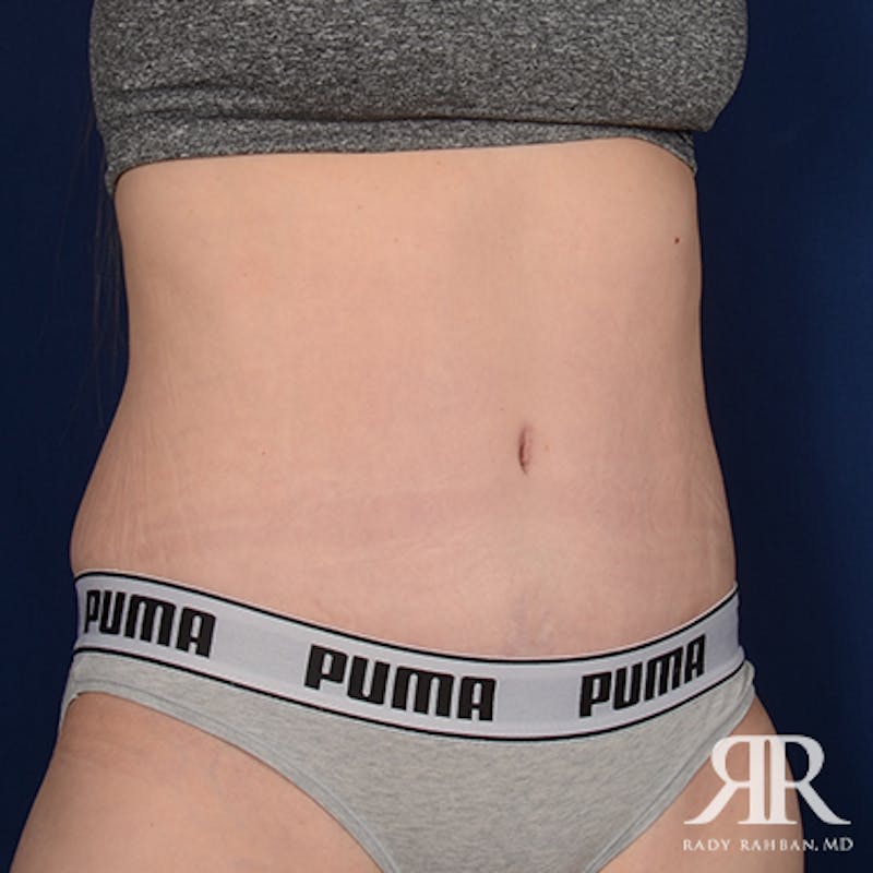 Tummy Tuck Before & After Gallery - Patient 624749 - Image 4