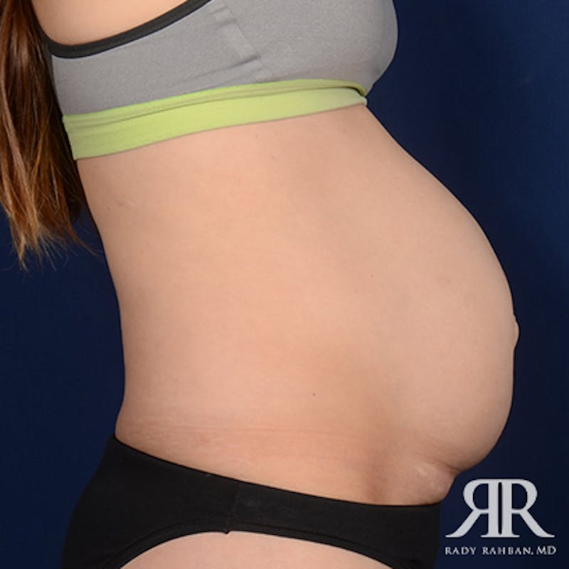 Tummy Tuck Before & After Gallery - Patient 624749 - Image 5