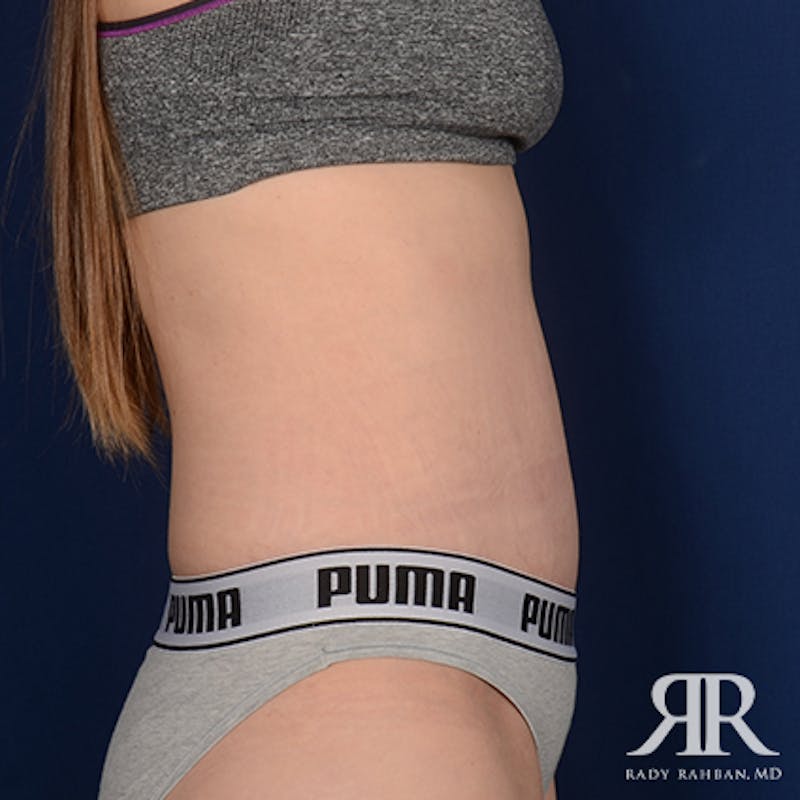 Tummy Tuck Before & After Gallery - Patient 624749 - Image 6