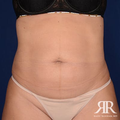 Tummy Tuck Before & After Gallery - Patient 936630 - Image 1