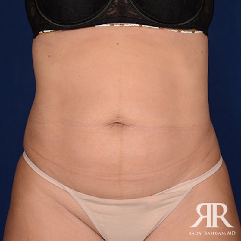 Tummy Tuck Before & After Gallery - Patient 936630 - Image 1