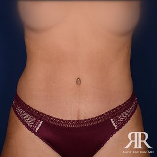 Tummy Tuck Before & After Gallery - Patient 936630 - Image 2