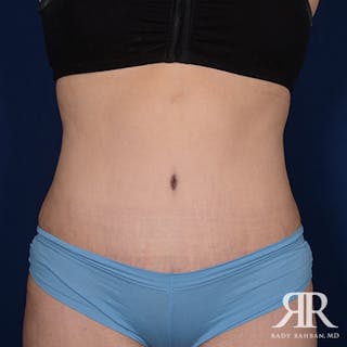 Tummy Tuck Before & After Gallery - Patient 119021 - Image 2