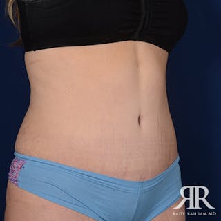 Tummy Tuck Before & After Gallery - Patient 119021 - Image 4