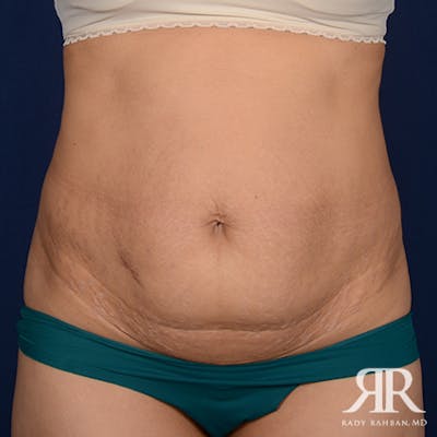 Tummy Tuck Before & After Gallery - Patient 308901 - Image 1