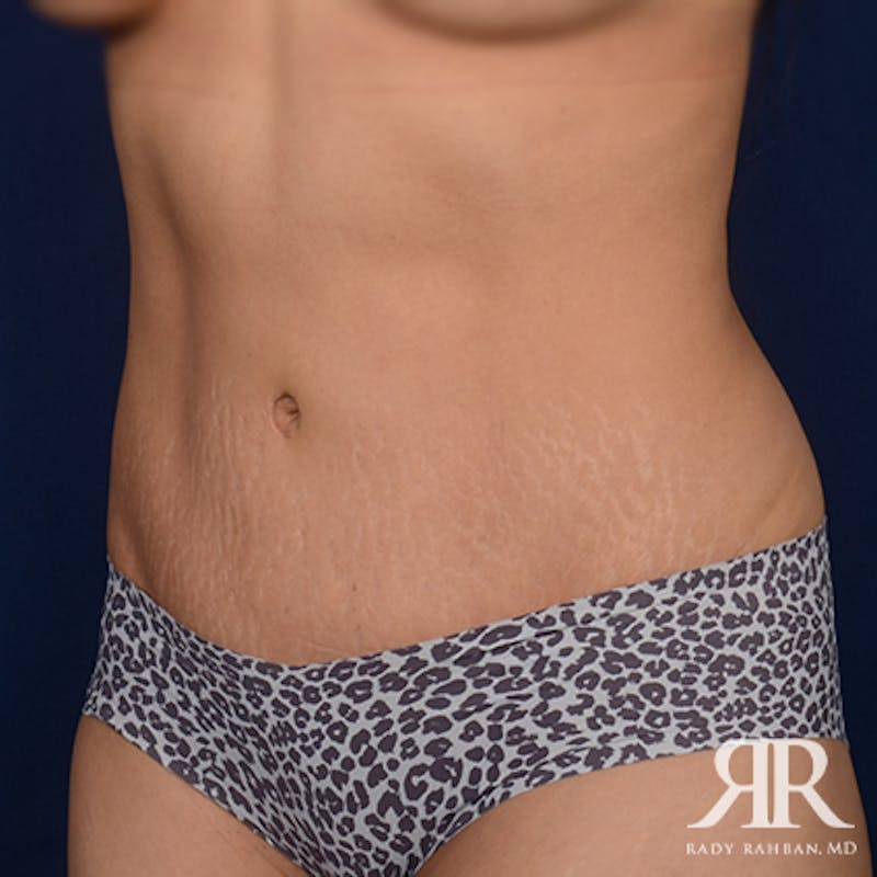 Tummy Tuck Before & After Gallery - Patient 308901 - Image 4