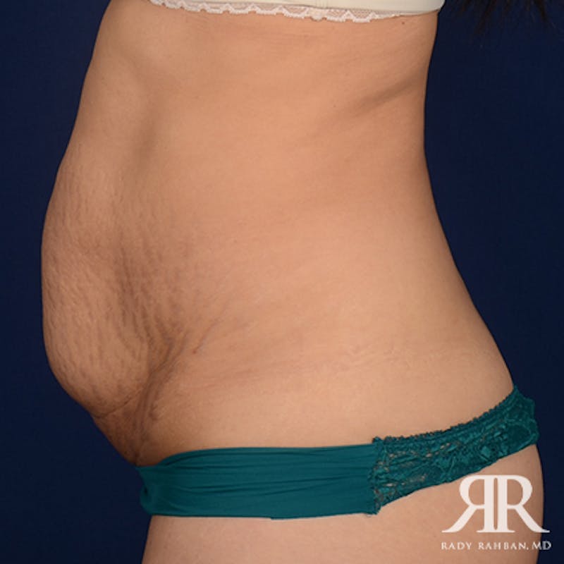 Tummy Tuck Before & After Gallery - Patient 308901 - Image 5