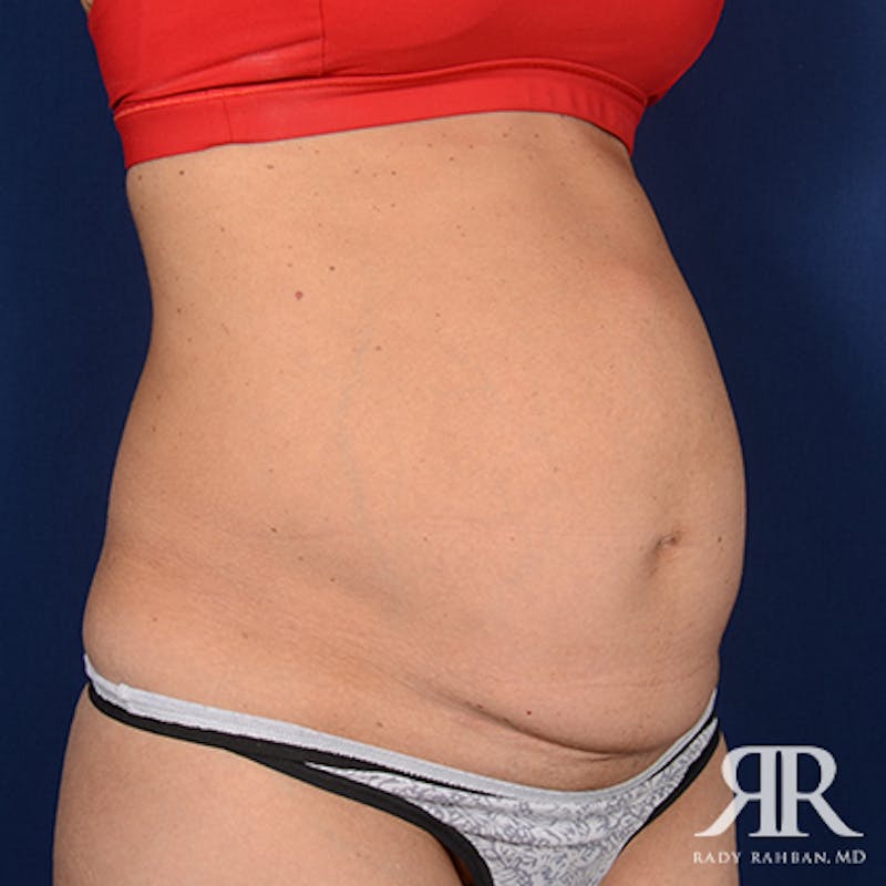 Tummy Tuck Before & After Gallery - Patient 206469 - Image 3