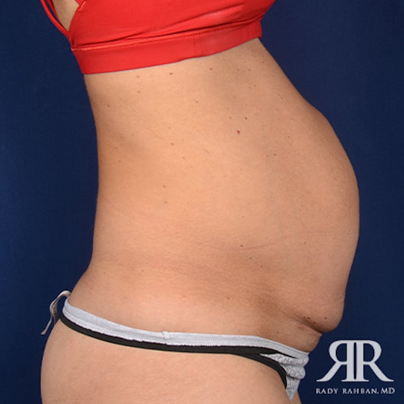Tummy Tuck Before & After Gallery - Patient 206469 - Image 5