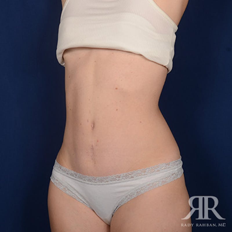 Tummy Tuck Before & After Gallery - Patient 192062 - Image 4