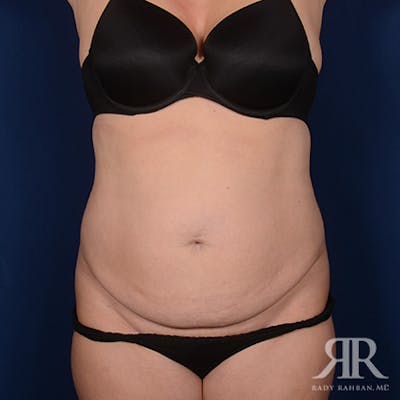 Tummy Tuck Before & After Gallery - Patient 409122 - Image 1