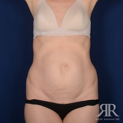 Tummy Tuck Before & After Gallery - Patient 404048 - Image 1