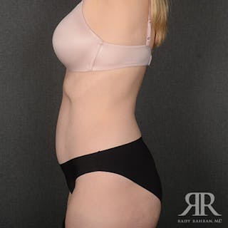 Tummy Tuck Before & After Gallery - Patient 404048 - Image 6